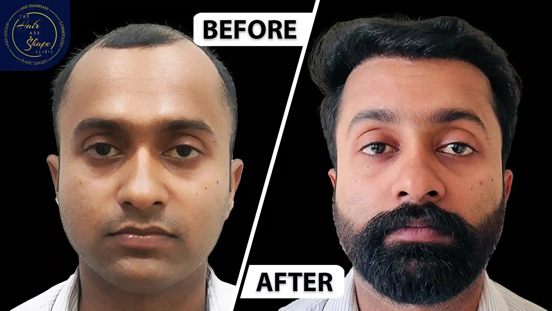 Hair Transplant result11